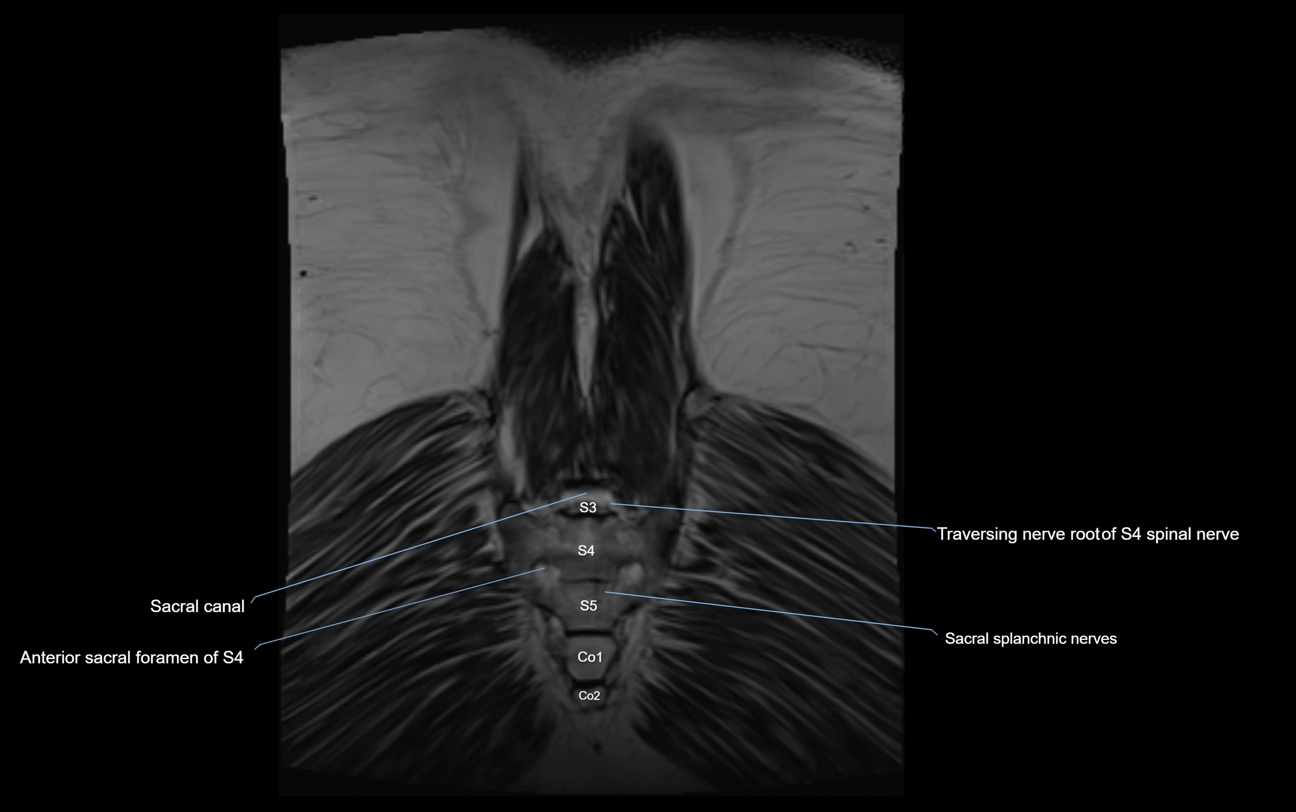 MR lumbosacral plexus cross sectional anatomy 3T  radiology  image-img-09001-00080.webp